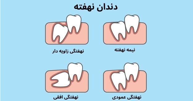 انواع دندان عقل از نظر زاویه رویش