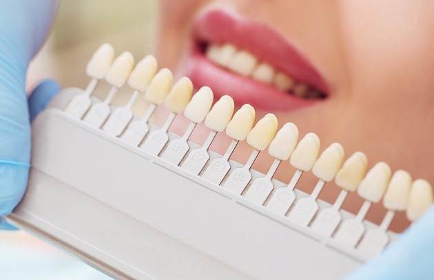 روش‌های سفید کردن دندان‌ها توسط دندان‌پزشک