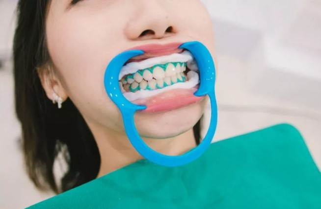 پروسه سفید کردن دندان‌ها توسط دندان‌پزشک