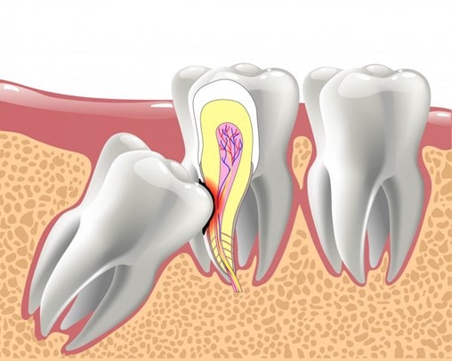 آیا جراحی دندان عقل نهفته ضروری است؟