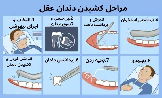 مراحل جراحی دندان عقل نهفته