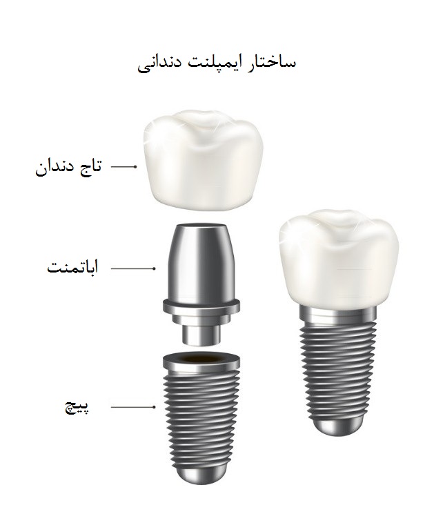 ایمپلنت‌های دندانی از سه قسمت تشکیل شده‌اند