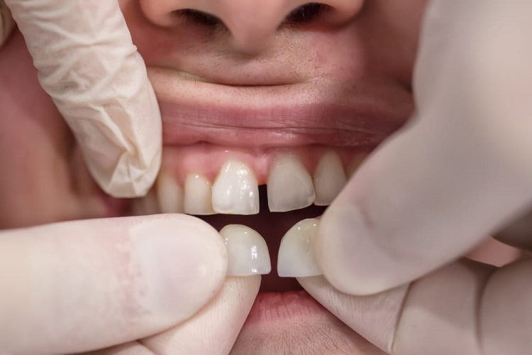 لمینت های بدون تراش چه انواعی دارند؟