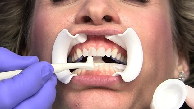 کامپوزیت دندانی بهتر است یا روکش سرامیکی؟