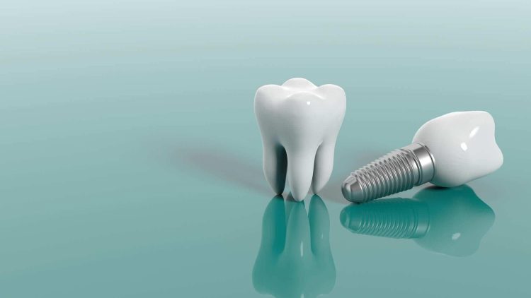 مینی‌ایمپلنت دندانی چه مزایایی دارد؟