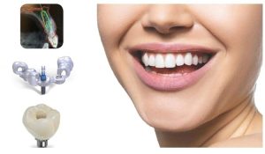 خانه 6 ایمپلنت دندانی دیجیتال چیست و چه مزایایی دارد؟