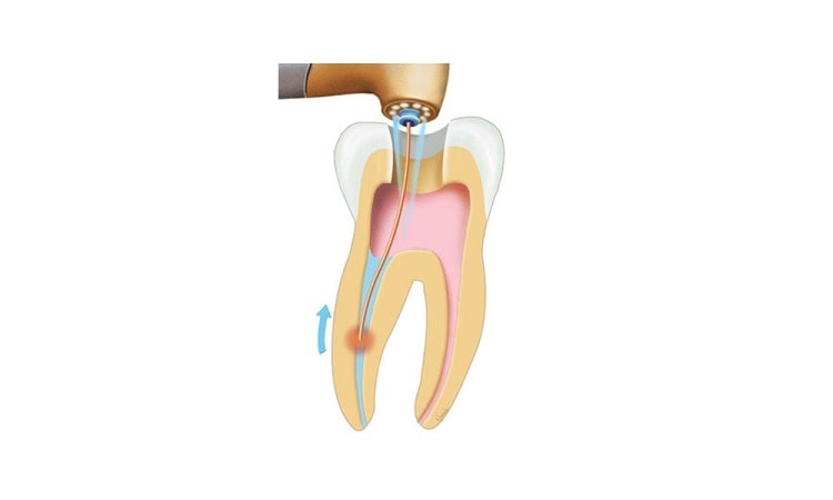 عصب کشی دندان با لیزر چگونه انجام می شود وچه مزایایی دارد؟
