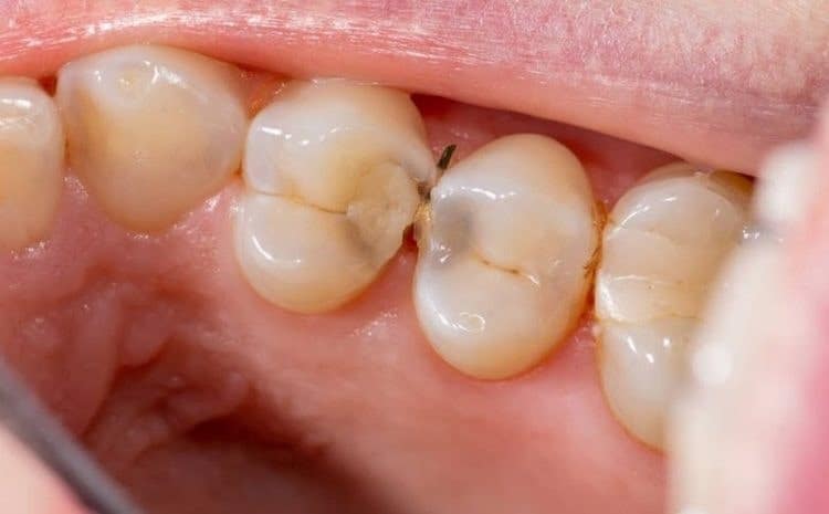 دلایل عفونت دندان
