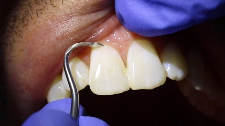 خطرات جرم گیری دندان