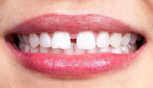 علت‌های بروز فاصله بین دندان‌ها