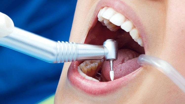 فاکتورهای موثر بر هزینه عصب کشی دندان