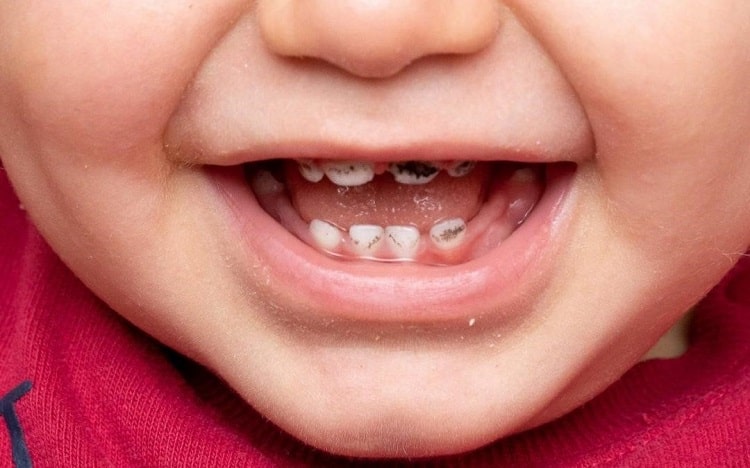 سیاه شدن دندان اطفال و کودکان