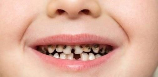 علت سیاه شدن دندان‌های اطفال