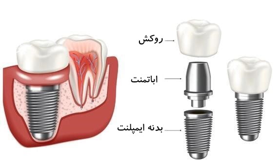 لق شدن اباتمنت ایمپلنت