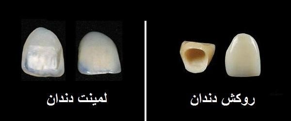 مقایسه لمینت و روکش دندان