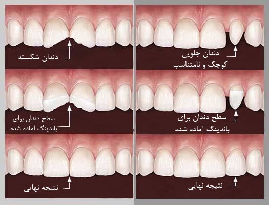 انواع باندینگ دندان