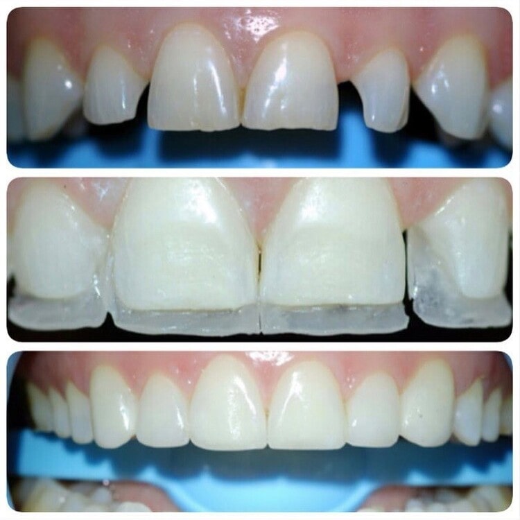 باندینگ دندان چیست؟