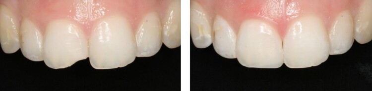 مزایای استفاده از باندینگ دندان