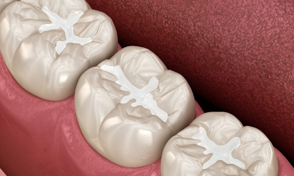 درمان ترمیم مینای دندان 